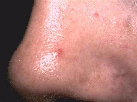 Basal Cell Carcinoma Tip Of Nose