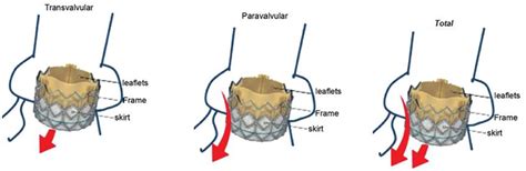 Paravalvular Leakage Assessment Of Cardiac Valve Prostheses Test Tip