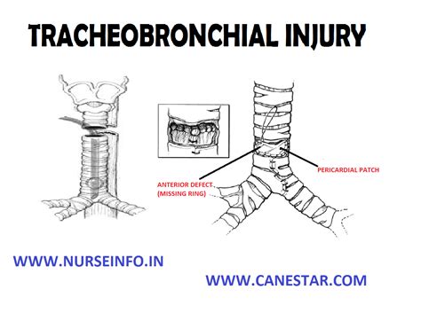 Tracheobronchial Injury Nurse Info