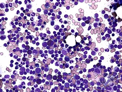 Peripheral T Cell Lymphoma Unspecified Bone Marrow Aspirate 1