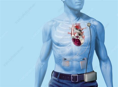 Artificial Heart Artwork Stock Image M5610104 Science Photo Library