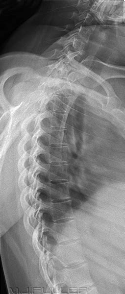 Modified Lateral Thoracic Spine Technique Wikiradiography