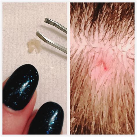 Lanced Emptied And Extracted A Pilar Cyst On My Scalp Rpopping