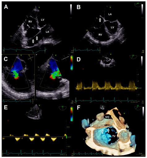 Percutaneous Edge To Edge Tricuspid Valve Repair In A Patient With Cor