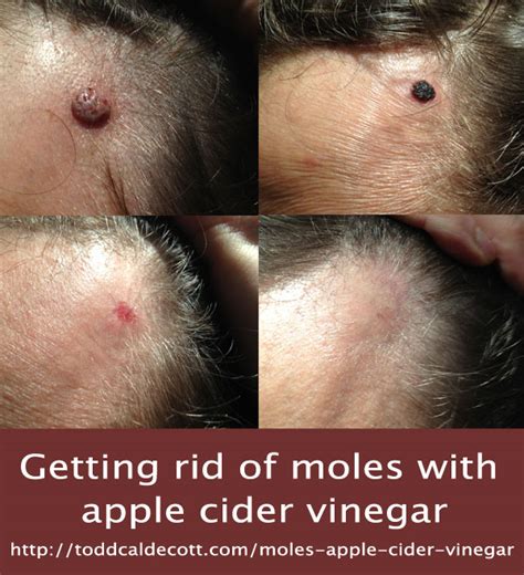 Moles And Apple Cider Vinegar
