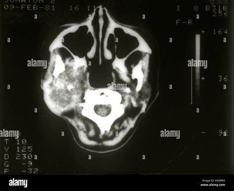 Una Tomografía Computarizada Que Muestra Un Gran Tumor De La Glándula