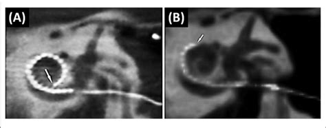 The Immediate Post Operative Ct Scan Shows A Fully Inserted Cochlear