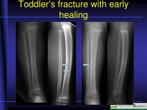 Ppt Pediatric Fractures Powerpoint Presentation Free Download Id