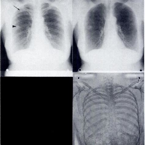 Pdf Conventional Chest Radiography Vs Dual Energy Computed