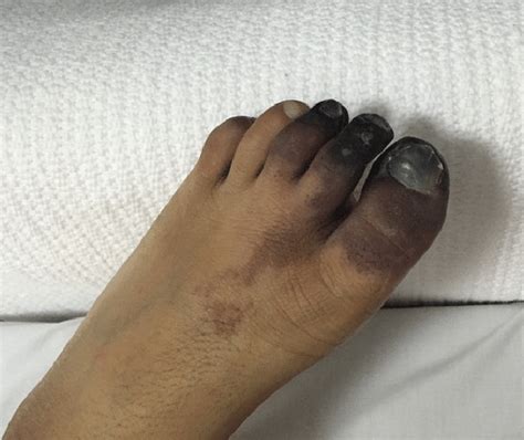 Picture Of The Left Foot Upon Admission Dark Skin Discoloration