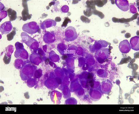 Cancer Cells Stock Photo Alamy