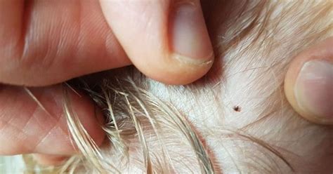 Mum Shares Lyme Disease Warning After Son Gets Tick Bite At National