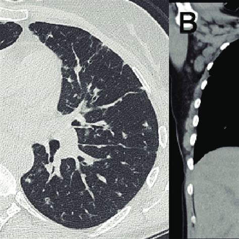 A Chest Ct Scan Demonstrated Bilateral Perilymphatic Nodules Without