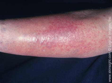 Stasis Dermatitis Causes Treatment Symptoms Pictures