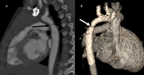 Coarctation Of Aorta Ct My XXX Hot Girl