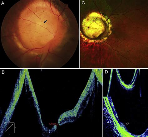 Treatment Of Recurrent Retinal Detachment Secondary To Optic Nerve