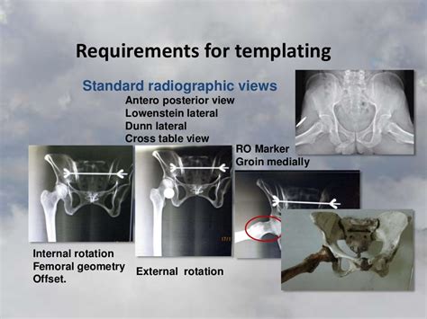 Templating Of Total Hip Replacement Thr