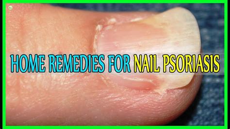 Gently apply avocado oil to the. Best Home Remedies For Nail Psoriasis! - YouTube