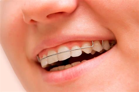 Orthodontics Australia Orthodontic Retainers For Teeth Fixed And