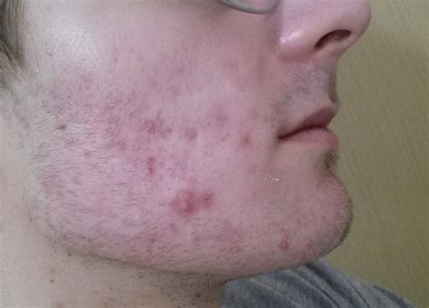 6 Months Tretinoin Isnt Working For Me Could It Be Fungal Acne