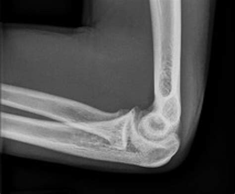 Surgical Treatment Of Displaced Olecranon Fracture Through A Persistent