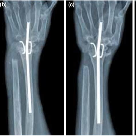 Pdf Wrist Arthrodesis With The Wrist Fusion Rod For Patients With
