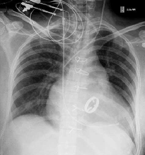 Chest Xray Showing Temporary Pacemaker Artificial Mechanical Mitral