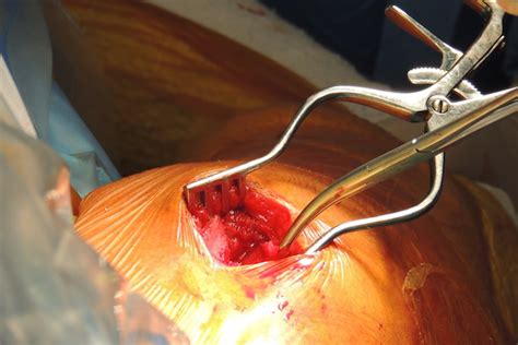 During open repair, a surgical incision is made and a large muscle (the deltoid) is. Rotator cuff tear