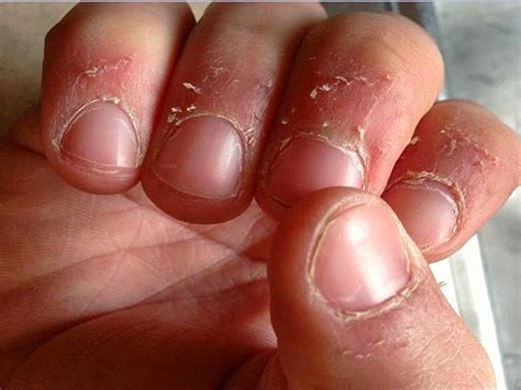 Sintetiza 55 Imágenes Sobre Como Quitar Los Cueros De Las Uñas El