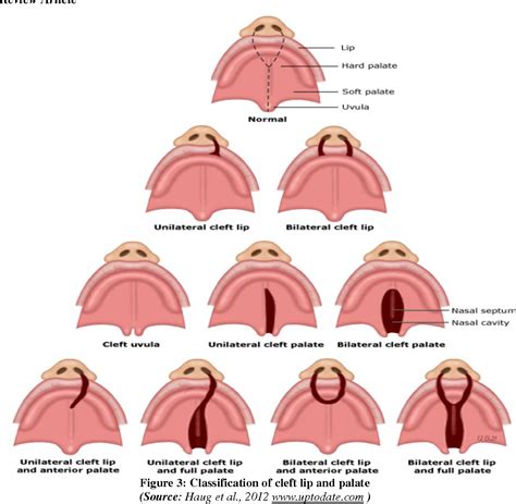 Classification Of Cleft Lip And Palate Cleft Lip Cleft Lip And