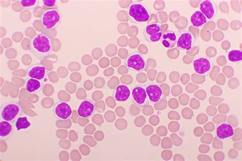 Picture Of Acute Lymphocytic Leukemia Or All Stock Image Image Of
