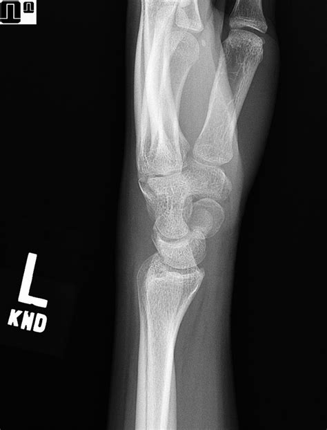 A 14 Year Old Girl With Wrist Pain And Swelling Jbjs Image Quiz