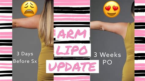 Arm Lipo 6 Week Update Surgery Vlog Bbl Surgery Vlog Youtube