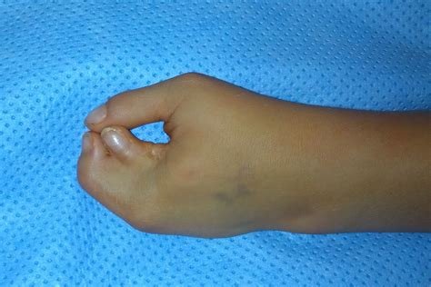 Symbrachydactyly Web Deepening Congenital Hand And Arm Differences