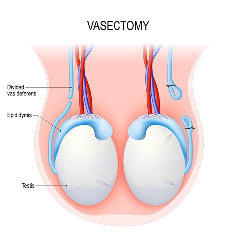 The most common side effects during recovery are bruising, swelling, and pain. Everything About Vasectomies