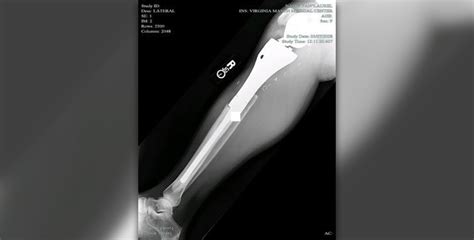 Tibia Fracture Surgery General Center
