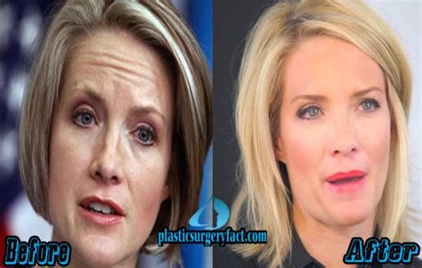 Dana Perino Plastic Surgery Before And After