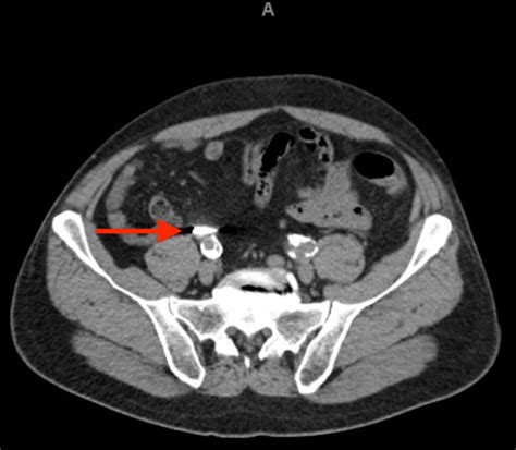 Cureus A ‘bit Of Appendicitis A Case Of A Foreign Object In The