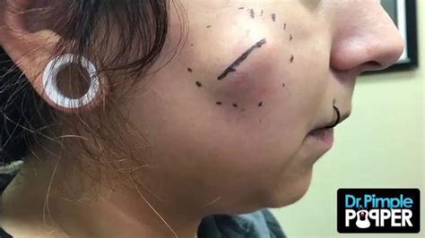 Dr Pimple Popper See This Monster Cheek Cyst Explode After A Few