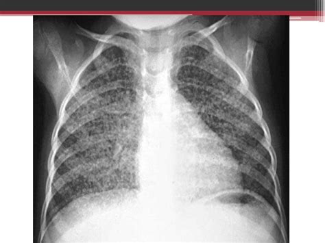 Tuberculosis Pleural