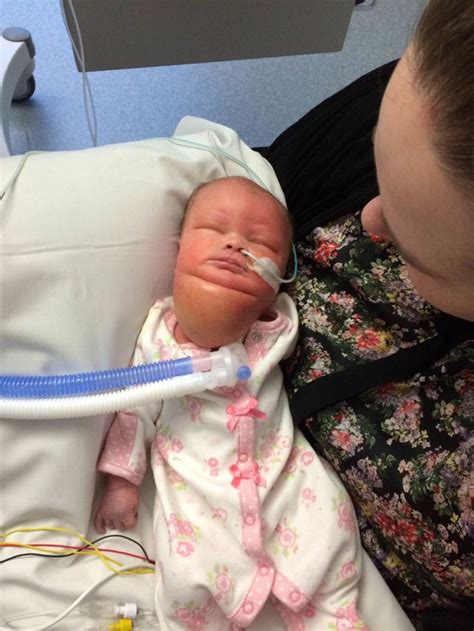 Baby Who Was Born With A Massive Neck Tumor Celebrates First New Year