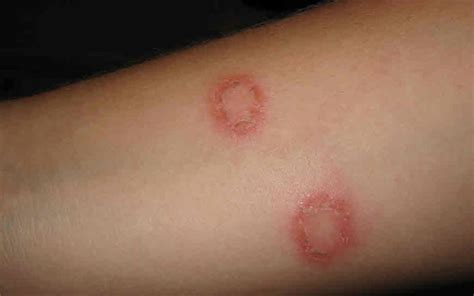 Ayurvedic Herbal Medicine For Ringworm And How To Cure Ringworm Fast