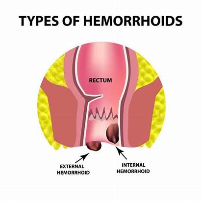 Internal Hemorrhoids Causes Stool Blood External Std