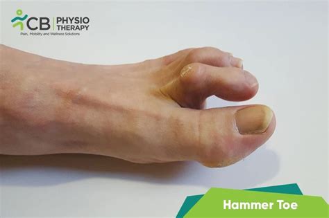 What Is Hammer Toe Symptoms Causes Diagnosis And Physiotherapy