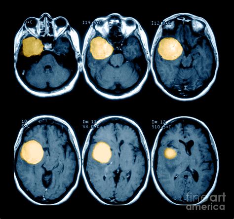 Brain Tumor Photograph By Medical Body Scans Pixels
