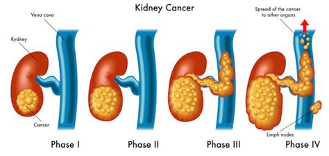 Kidney Cancer Causes Symptoms And Treatment Clicks Health Hub