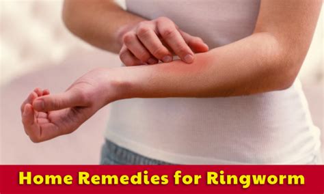 Home Remedies For Ringworm Learningjoan