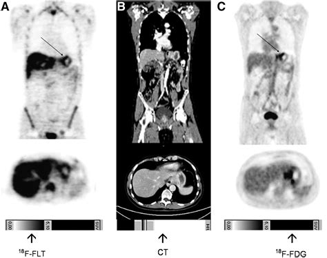 Imaging Gastric Cancer With Pet And The Radiotracers 18f Flt And 18f