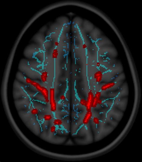 Symptomatic White Matter Changes In Mild Traumatic Brain Injury