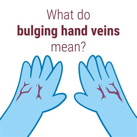 Causes Of Bulging Veins Delaware Vein Center
